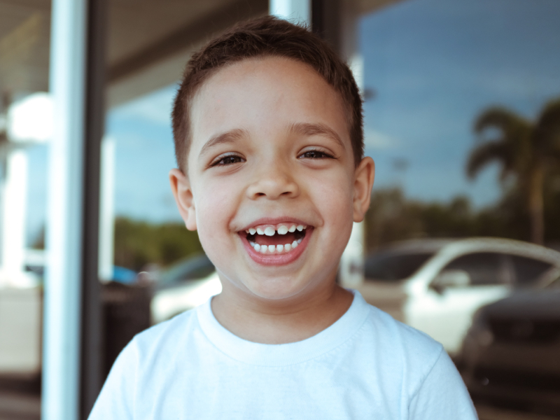 Bonded Resin Tooth Colored Fillings